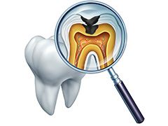 重度の虫歯は根管治療で歯を残す