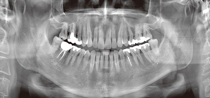 歯科用CT