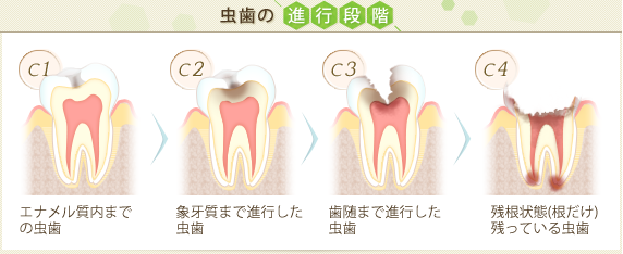 虫歯の進み方