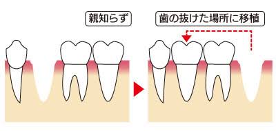 自家歯牙移植