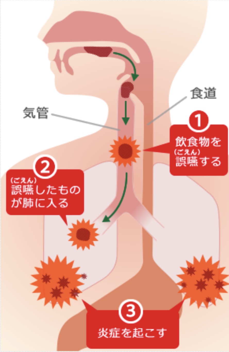 歯周病と誤嚥性肺炎