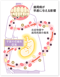 歯周病と妊娠