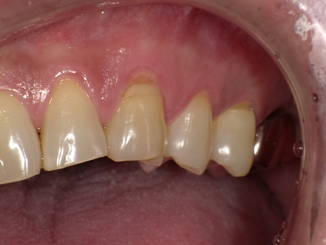 「tooth wear」の原因と対策
