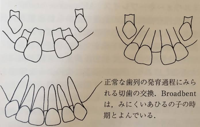 乳歯から永久歯への生えかわりの時期によく見られること