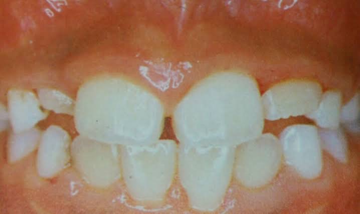 乳歯から永久歯への生えかわりの時期によく見られること