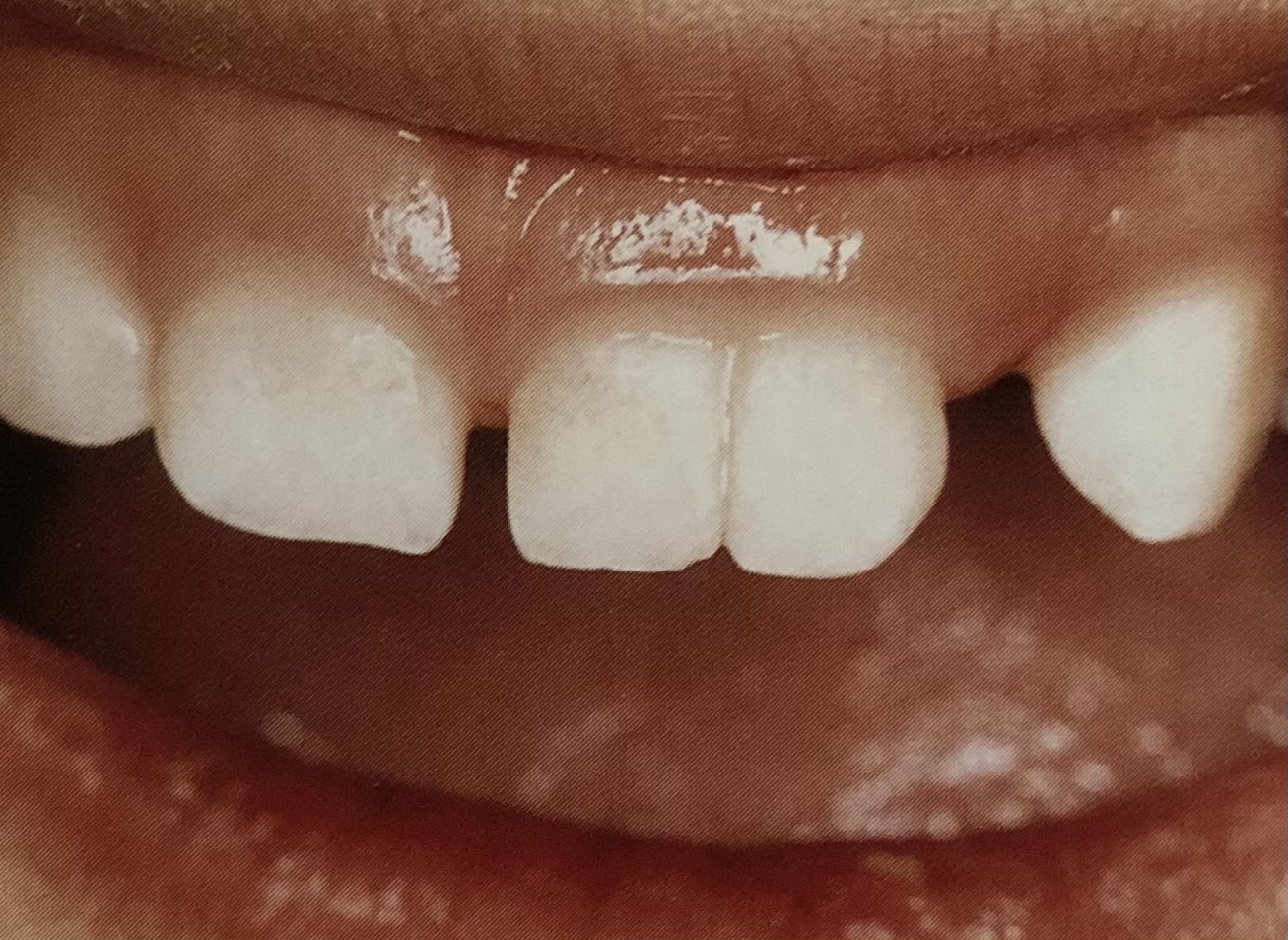 歯の形態異常