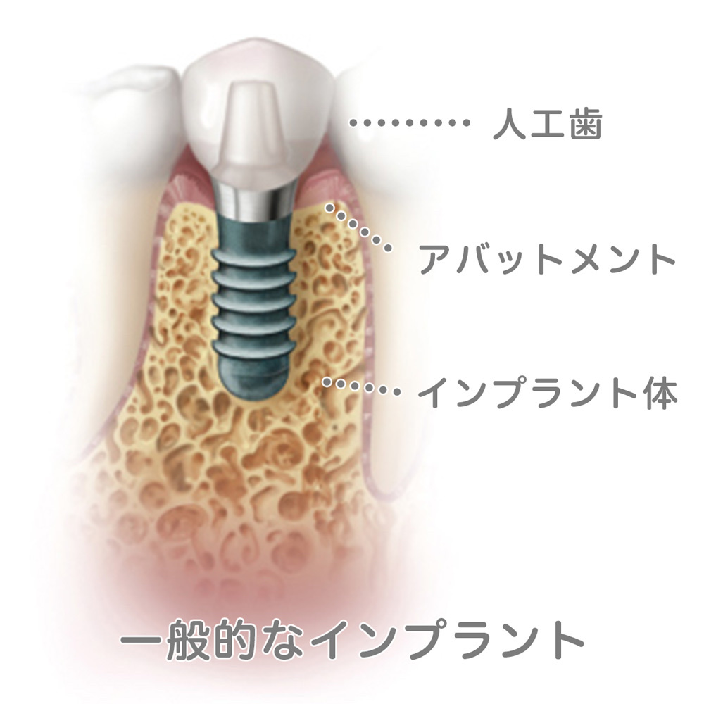 インプラントオーバーデンチャー