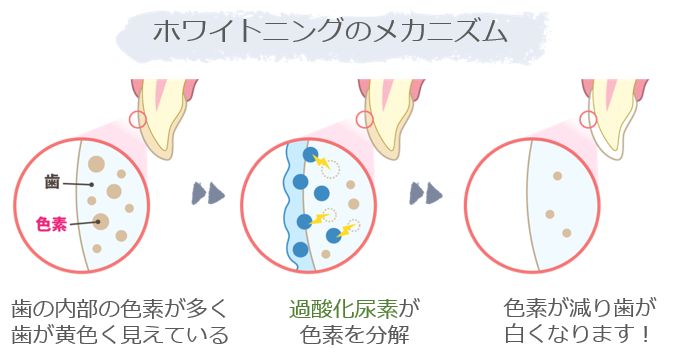 ホワイトニングで歯を白く！