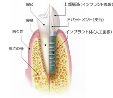 インプラントの構造