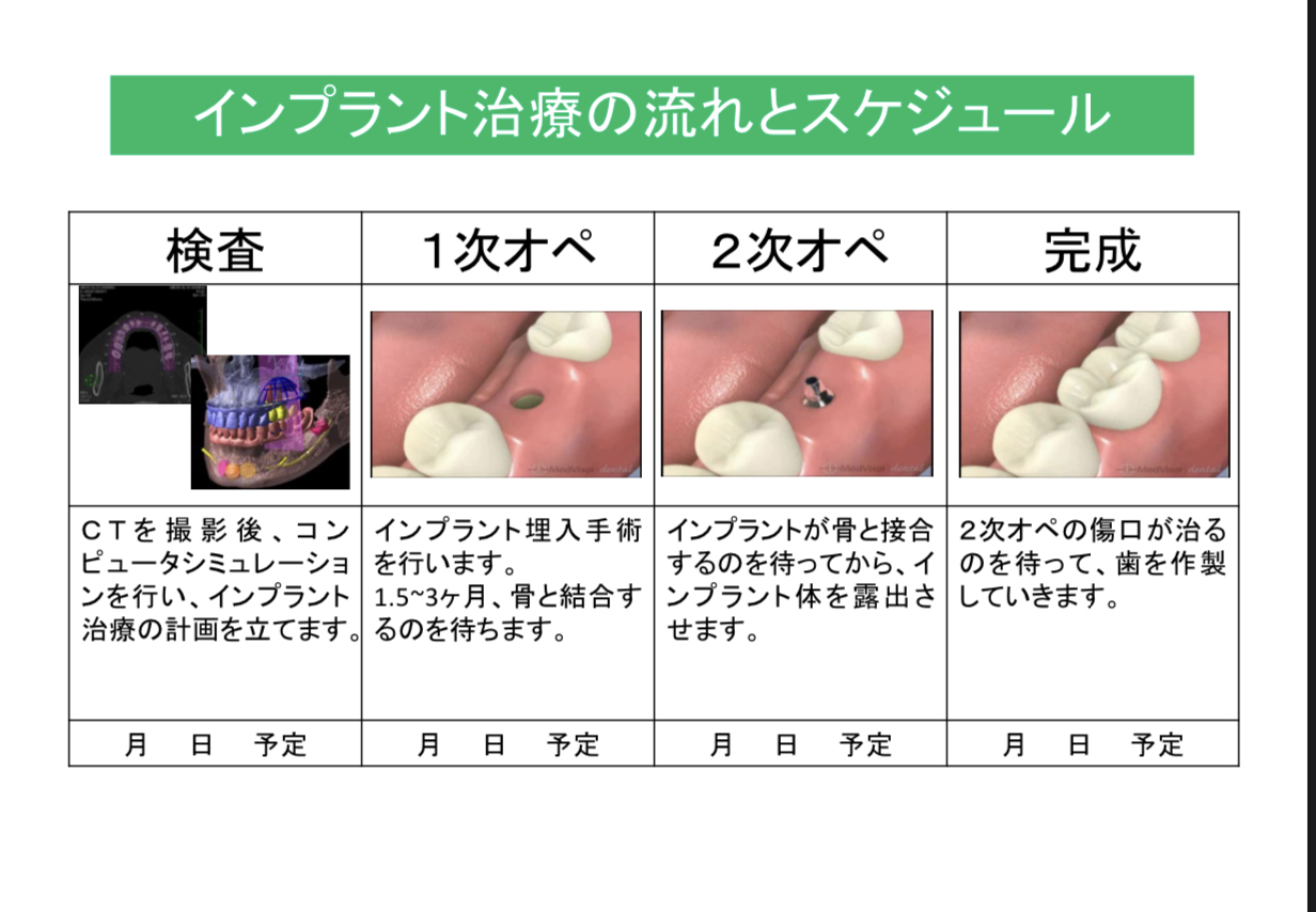 インプラント手術の方法