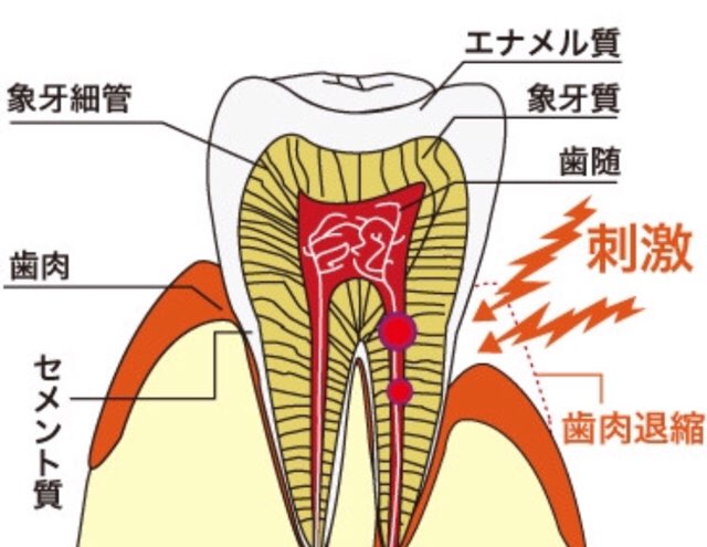 知覚過敏症