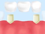 ブリッジ治療
