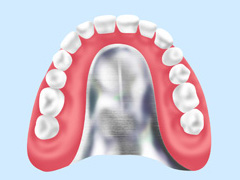 金属床義歯（自費診療）