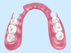 ノンクラスプデンチャー（自費診療）