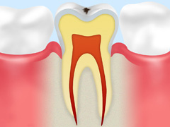 CO：初期の虫歯