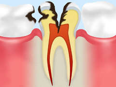 C3：歯の神経の虫歯