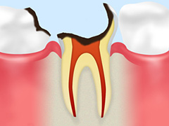 C4：歯根に達した虫歯