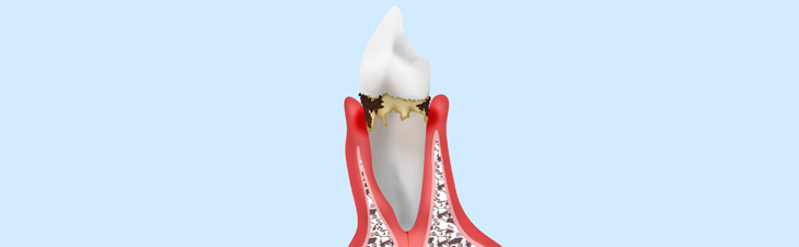 歯を失くさないために早期発見・早期治療を～歯周病～