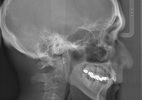 歯科用CT