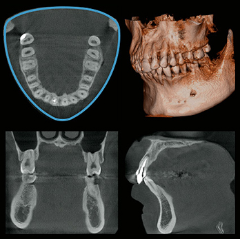 歯科用CT